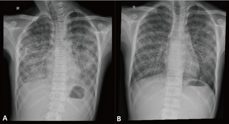 A Pediatric Case Of Relapsed Pulmonary Alveolar Proteinosis Despite