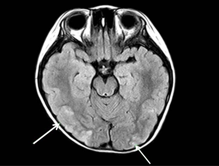 posterior reversible encephalopathy syndrome an atypical presentation of takayasu arteritis