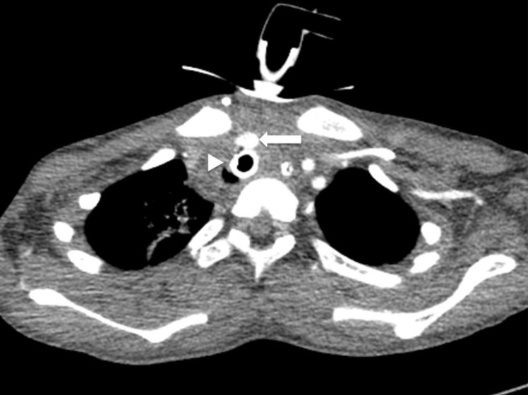 Endovascular stenting of tracheoinnominate fistula after tracheostomy ...